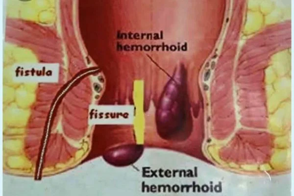 Perineal Surgery